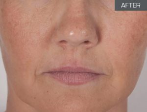 Environmentally Damaged Skin (after 4 months treatment and home care)