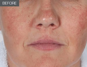 Environmentally Damaged Skin (before)