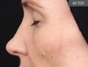 Hyperpigmented Skin (after 9 months - treatment and home care)