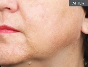 Hyperpigmented Skin (after 5 months - treatment and home care)