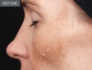 Hyperpigmented Skin (before)