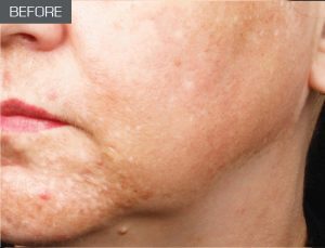 Hyperpigmented Skin (before)