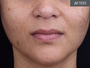 Problematic Skin (after 3 months treatment and home care)