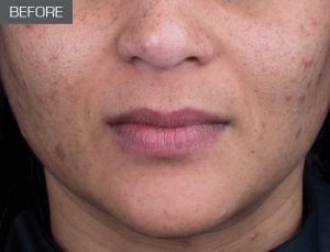 Problematic Skin (before)